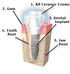 dental implants huntington beach