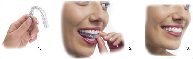 invisalign huntington beach