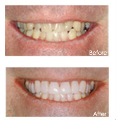 porcelain veneers huntington beach